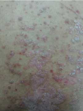 Figure 3. Exacerbation of psoriasis under immune checkpoint inhibitors; plaque psoriasis with silvery scales on trunk.