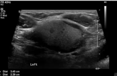 Fig. 2. Preoperative Neck ultrasonography finding showed a mass  in the left thyroid gland, filled with cellular materials, measuring  3.5×2.3cm.