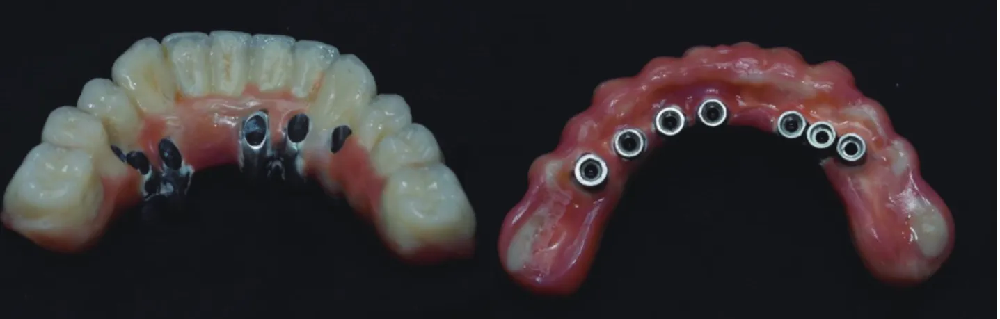 Fig 1-32.  crea.lignFig 1-30.  핑크레진까지 완성된 모습. 임플란트 주변은 청소가 잘 될수있도록 디자인해줍니다. Fig 1-31. 보철물의 내부구조 1