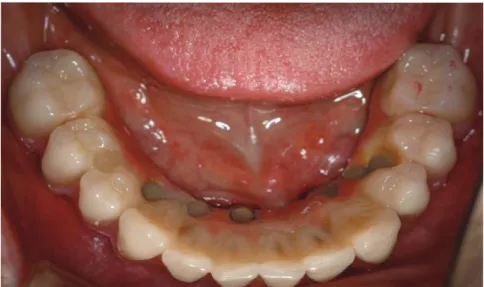 Fig 1-34.  하악의 Hybrid denture 가 장착된 사진