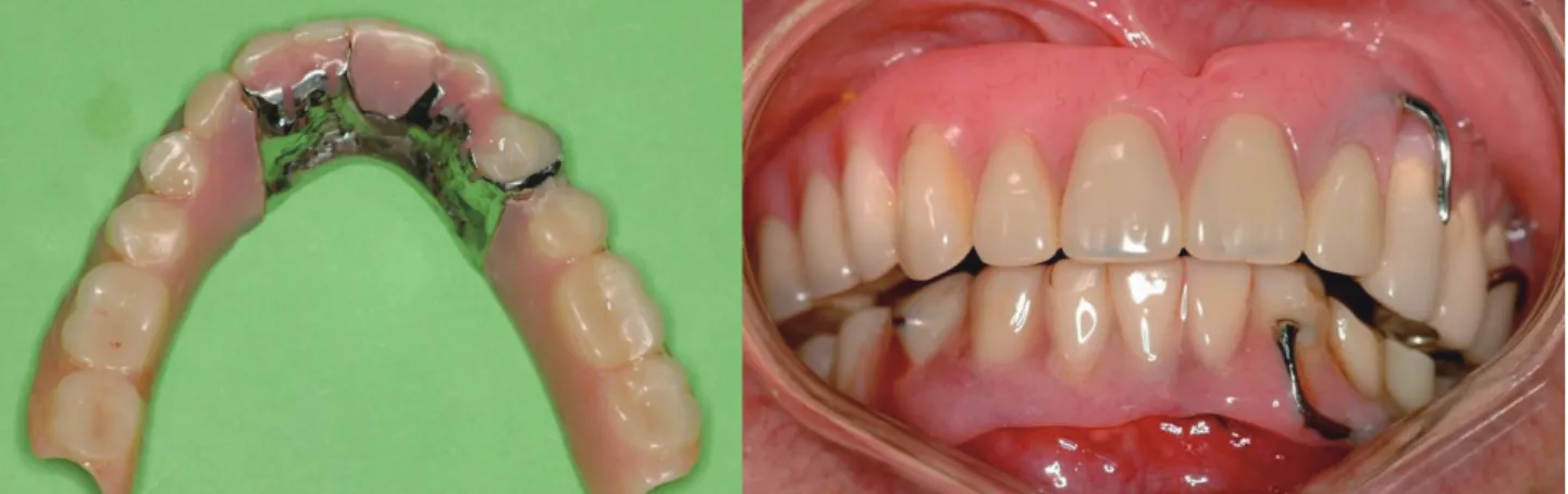 Fig 1-3.  기존의 사용하던 의치를 수리하여 임시의치로 사용한다