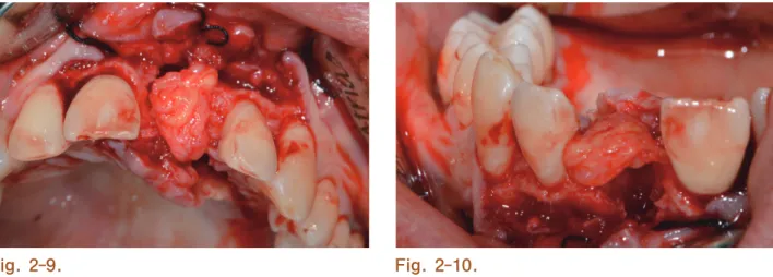 Fig. 2-9. Fig. 2-10. Fig  2-11.  임플란트 식립 직후 교합면측 모습으로서 순측에  2mm 이상의 골 두께를 확보하기 위해 인접치의 절단연을 연결한  가상선의 구개측에 임플란트가 위치하고 있는 모습