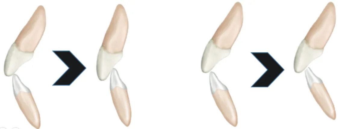 Fig. 3.  Overjet량이 적고 overbite량이 클수록 치아간의 접촉은 긴밀해지며, 시간에 따른 마모량이 늘어나게 된다(좌). 뿐만 아니라  접촉시의 접촉면적이 커질수록 마모량도 늘어난다(우)