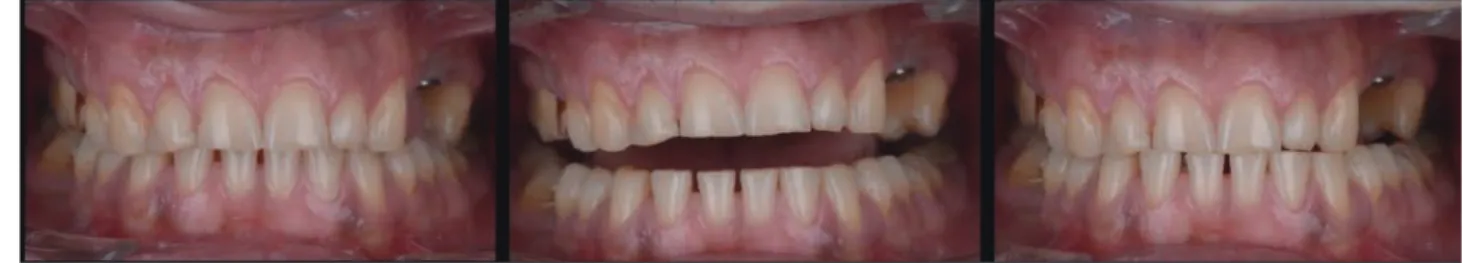 Fig. 24.  정면에서 본 사진과 개구와 폐구시의 사진