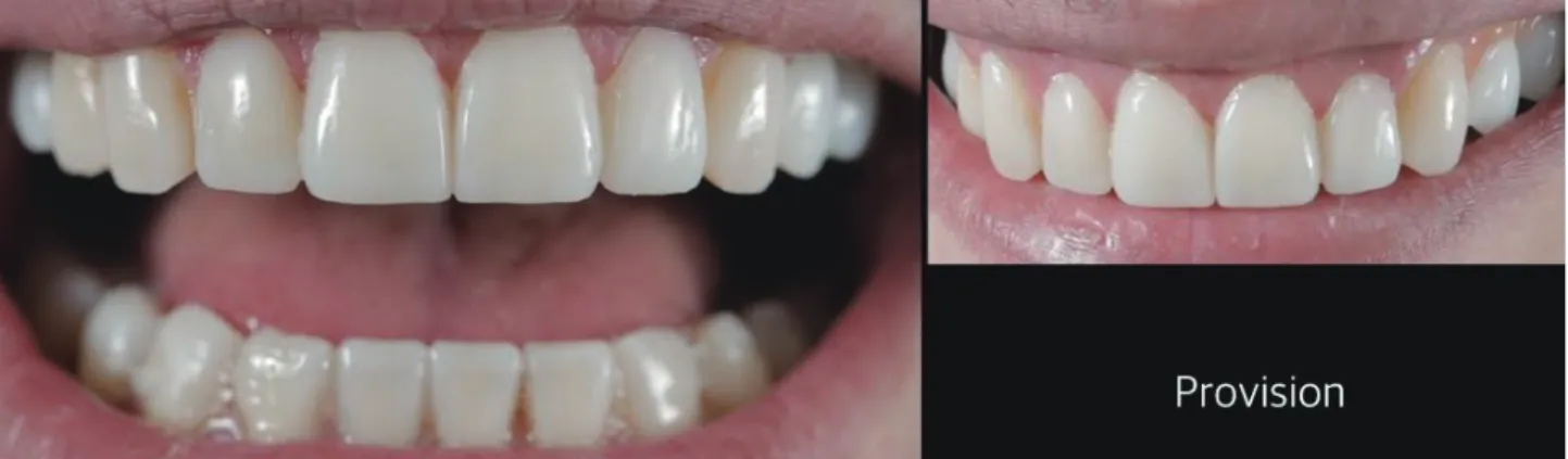 Fig. 29.  진단 왁스업을 이용한 Provisional Restoration