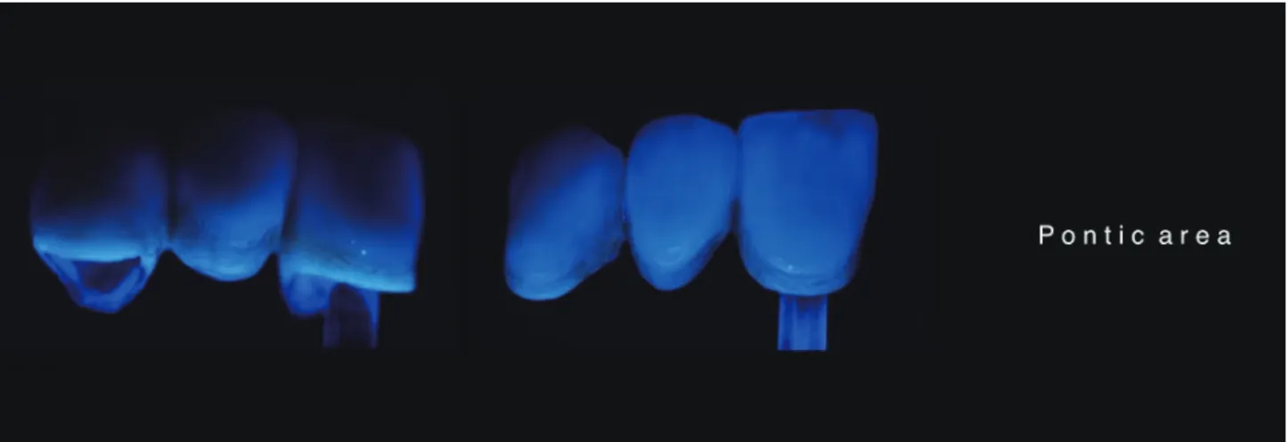 Fig. 14.  Metal ceramic  3 unit Bridge의 색의 조화
