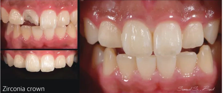 Fig 18.  Metal ceramic의 구강내 매칭 순간과 자연스런 색과 형태의 조화를 이룬 모습