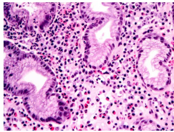 Table 1. Association between the density of gastric mucosal eosinophils and the