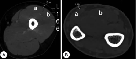 Fig. 2. Measurement of thickness of flap. A : Thickness of anterolateral thigh flap from CT image