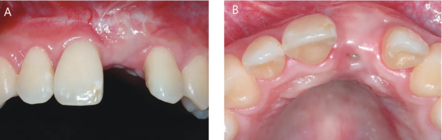 Fig. 6.  경조직 수술 후 5개월. A) 개선된 연, 경조직 모습을 볼 수 있는 협측 사진. B) 설측에 차단막이 일부 노출된 모습을 보였지만,  변연부의 노출과 염증 소견 없이 유지가 되고 있는 교합면 사진