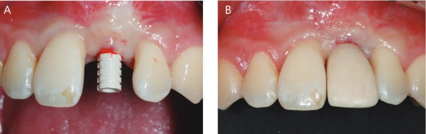 Fig. 8.  고정체 식립 5개월 후 임시치아장착. A) 펀치(Punch)형 절개 후 임시지대주를 장착한 사진. B) 당일 제작하여 장착한 나사유 지형 임시보철물 사진