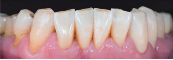 Fig.  1.  하악  4전치  Chang’s  Shade  Block을  이용한  full  zirconia 수복물 