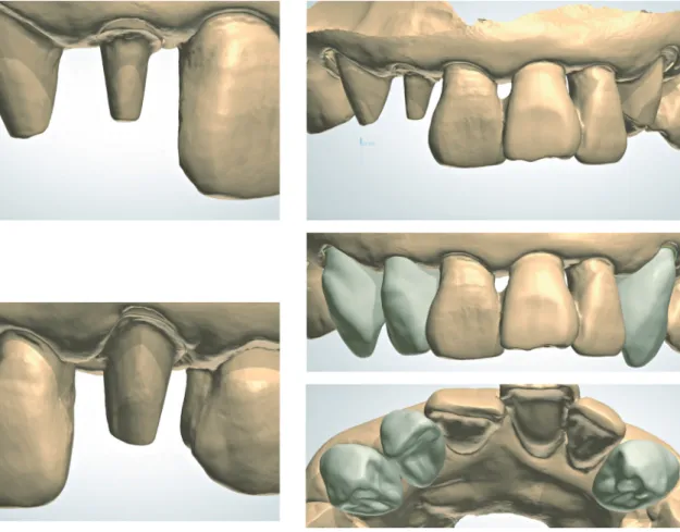 Fig. 6.  구강 스캔 데이터에 디자인하는 과정