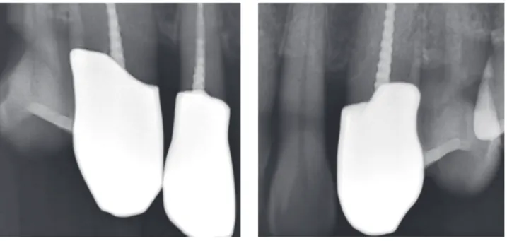 Fig. 9.  보철물 장착 후 치근단 방사선 사진