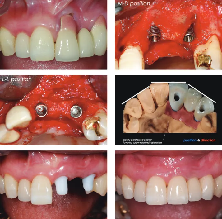 Fig. 4.  Case presentation 1. A: 초진. 상악 좌측 중절치, 견치부위의 순측 치조골과 부착치은의 소실이 관찰된다. B: 식립된 매식체 의 근원심 위치, C: 식립된 매식체의 순설측 위치, D: 매식체의 식립방향을 보여주는 최종 보철물, E: 구강내에 연결된 최종 지대주, F: 