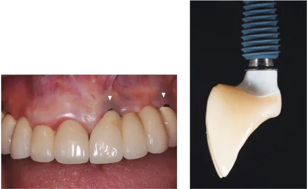 Fig.  5.  A: Following implant restoration, significant soft tissue recession and dark shadow under the  marginal gingival developed due to the labial implant placement, B: Ridge lap crown form.