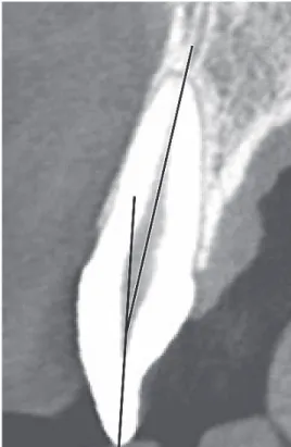 Fig. 6.  Axis of indivisual tooth. A: Root axis,  B: Crown axis (윗선은 a, 아래선은 b)