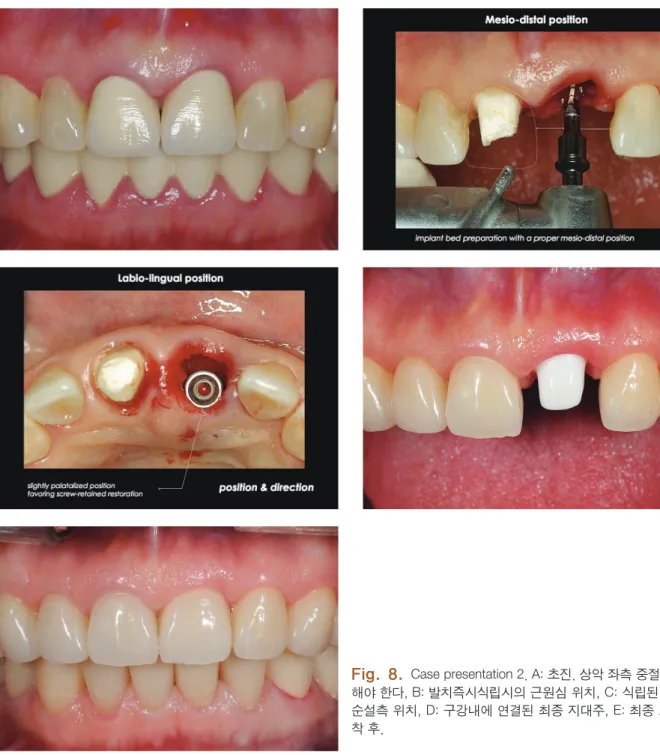 Fig. 8.  Case presentation 2. A: 초진. 상악 좌측 중절치를 발거 해야 한다, B: 발치즉시식립시의 근원심 위치, C: 식립된 매식체의  순설측 위치, D: 구강내에 연결된 최종 지대주, E: 최종 보철물 장 착 후.