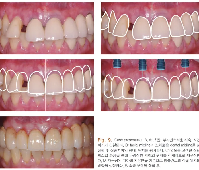 Fig. 9.  Case presentation 3. A: 초진. 부자연스러운 치축, 치간 이개가 관찰된다, B: facial midline과 조화로운 dental midline을 설 정한 후 잔존치아의 형태, 위치를 평가한다, C: 안모를 고려한 진단 왁스업 과정을 통해 바람직한 치아의 위치를 전체적으로 재구성한 다, D: 재구성된 치아의 치은연을 기준으로 임플란트의 식립 위치와  방향을 설정한다, E: 최종 보철물 장착 후.