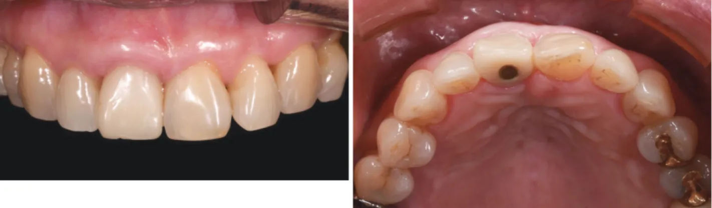 Fig. 14.  발치 후 오랜 시간이 지난 경우 골폭의 감소와 치은 치조점막 경계선의 치관부위로의 변위를 관찰할 수 있다. (Relative thin  ridge for molar teeth, Coronal displacement of keratinized gingiva)