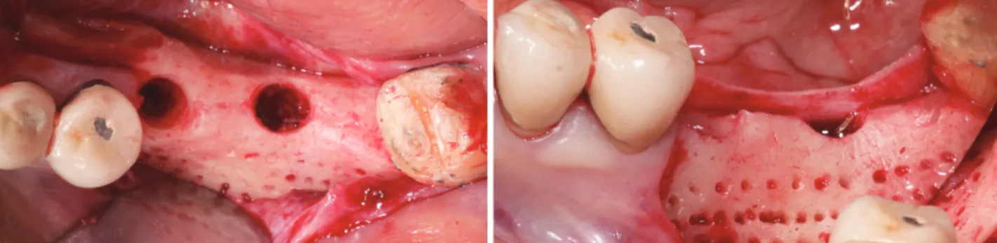 Fig. 15.  골유도 재생술시 골형성을 촉진하기 위해 이식할 부위의 골창 (bone hole)을 형성하였다. (Bone hole preparation: regional  accelerative phenomenon)