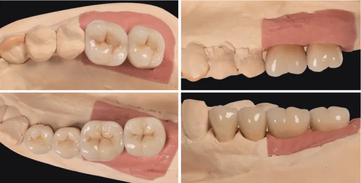 Fig. 18.  최종 보철물을 제작할 때 잇몸 하방의 치아 형태와 잇몸과 치아 경계부의 치아의 형태, 잇몸 상방의 치아의 형태 및 교합면  형태 모두에 대한 주의 깊은 배려가 필요하다
