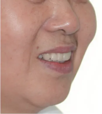 Fig. 11.  하악위의 안정을 위한 flat table을 이용한 치료용 의 치의 예