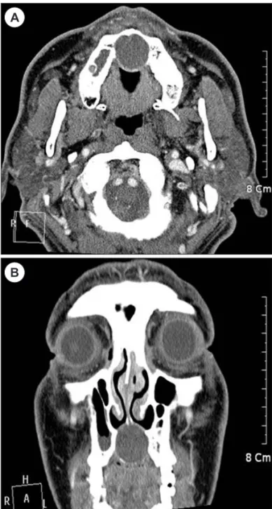 Fig. 1. Preoperative physical findings. 2.5×2.5cm sized mass on  midline of hard palate(Black asterisk).
