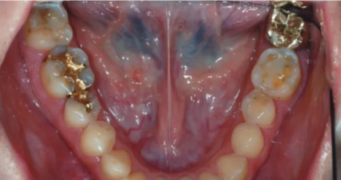 Fig. 2. Maxillary occlusal view showing extensive erosion of  virtually all teeth.