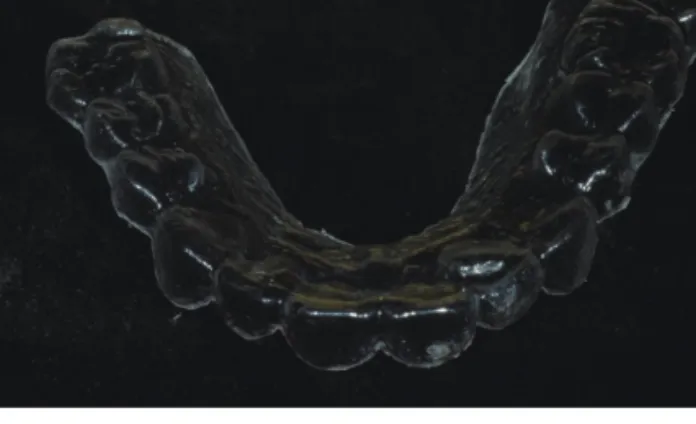 Fig. 7.  The line of gingivectomy was designed and drew on  the cast.
