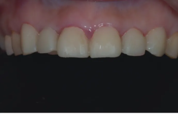 Fig. 15 a, b.  Ceramic crowns for maxillary incisors were fabricated on dies.
