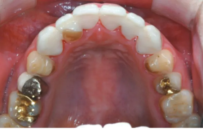 Fig.  16.   Maxillary  incisors  were  restored  with  ceramic  crowns luted with resin composite cement.