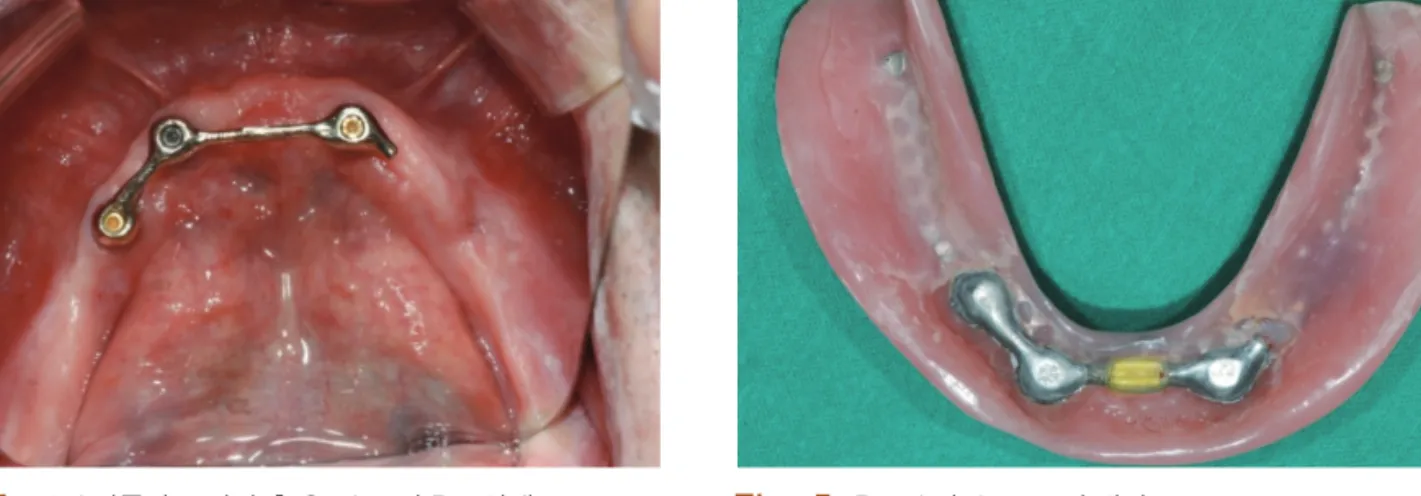 Fig. 6.  #12i 임플란트 발거하였고 상부 보철물 철거후 구강내  사진