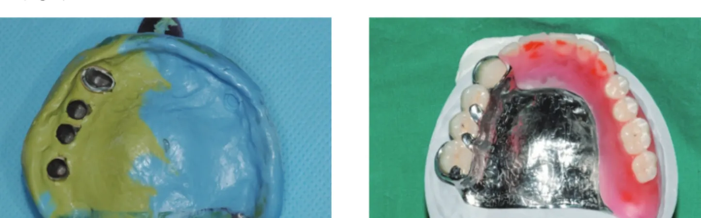 Fig. 8.  Framework 주조와 납의치 제작