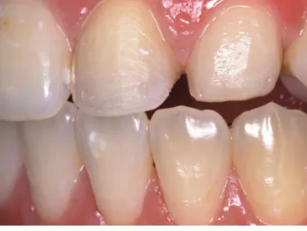 Fig. 3.  Completed laminate veneers on working cast. Fig. 4.  Post-treatment view of the maxillary left incisors.