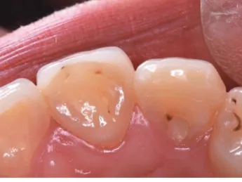 Fig.  6.  Palatal view 4 years after insertion. The black spot  was recognized between the restoration and central incisor.