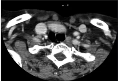 Fig. 1. Axial computed tomography scan shows an air cyst in the  right aspect of the trachea