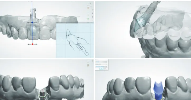 Fig. 28.  캐드캠을 통한 개별지대주 디자인 과정