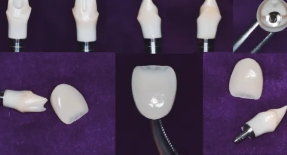 Fig. 29.  타이타늄 링크와 지르코니아 코어를 접착하여 준비한 개별지대주와 최종 보철물 Fig. 31.  치료종료후 임상사진 및 방사선사진Fig. 30