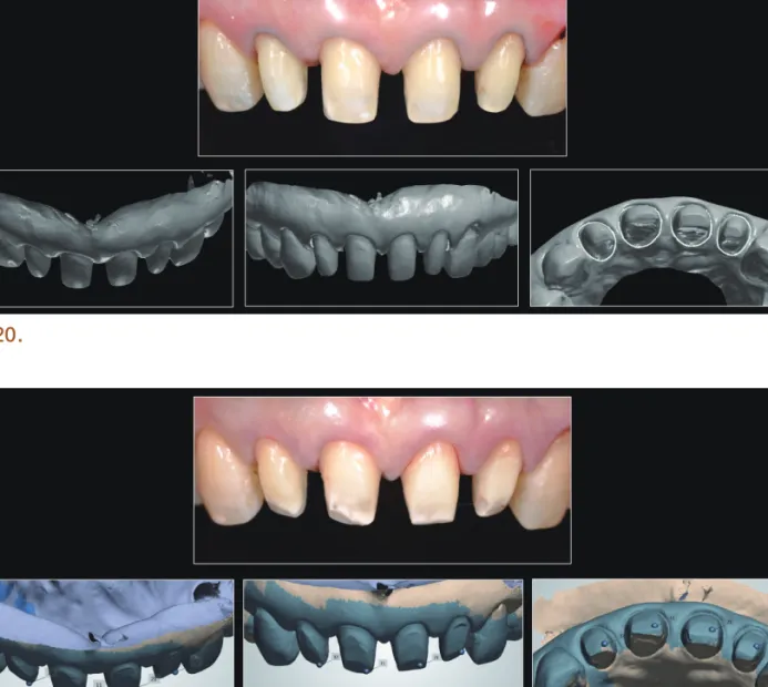 Fig. 22 는 작업한 보철물의 analogue와 digital의 결과인데, 각각의 작업 결과에 대해서도 아쉬운 점을 발견할 수 있 다 . 첫 번째 사진의 analogue를 통해 나타난 결과는 치경부 프로파일의 대칭성이 부족하였고, 두 번째 사진의 digital을  통해  나타난 결과는 열처리 과정에서 착오로 인해 일정부분 녹아버렸다