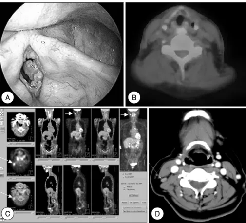Fig. 1. False negative(A, B) and false positive(C, D)  18 F-FDG PET/CT. A：A 75 year-old male with glottic cancer(initial stage T1bN0M0) at 4 years after undergoing anterior commisure laryngectomy