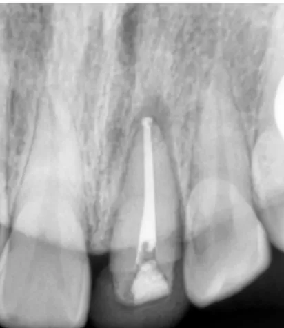 그림  27.   Initial  prep  후  사진 그림  28.   Final  prep  후  사진