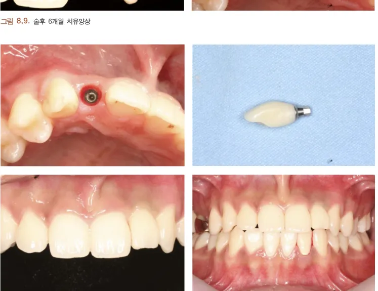 그림  10,11,12,13.   Provisional  restoration    