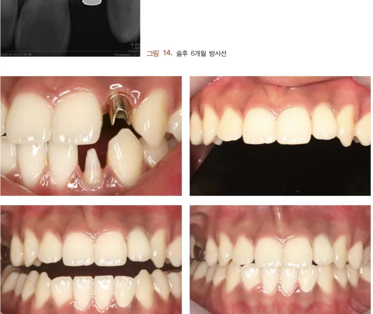 그림  15,16,17,18.   UCLA  type  Abutment와  Zirconia  final  restoration  (#22,32)
