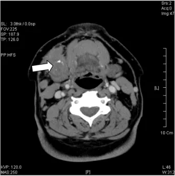 Fig. 2. Preoperative contrast enhanced axial CT image shows 3.6×3.7×4.8cm sized ill defined, lobulated mass with calcific change and central hypodense area in right submandibular gland(white arrow)