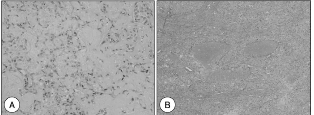 Fig. 6. Histopathologic findings. A：Part of pleomorphic adenoma sh-ows polygonal epithelial and spindle-shaped mesenchymal  elements[H&amp;E,  ×200]
