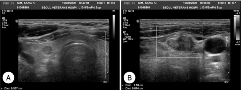 Fig. 3. Neck ultrasonography shows right thyroid gland and right level III mass. A：6mm sized round small low echogenic nodular  lesion in right thyroid gland