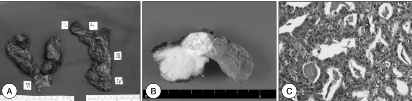 Fig. 5. This photograph shows gross and microscopic finding of specimen. A：Total thyroidectomy with ACND and right neck dissec- dissec-tion(level II, III, IV) specimen