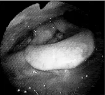 Fig. 4. Flexible laryngoscopy demonstrates normal epiglottis and arytenoid at the follow-up of the 3th month from discharge