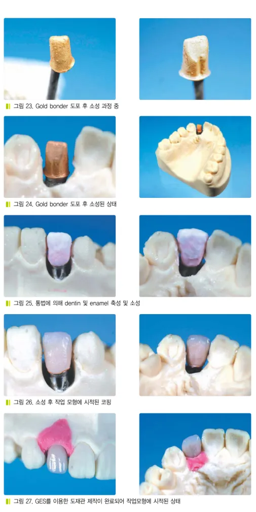 그림 25. 통법에 의해 dentin 및 enamel 축성 및 소성